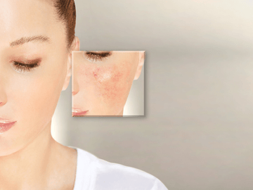 What is rosacea and how to treat it. - Essentially Haitos